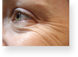 wrinkles_img1