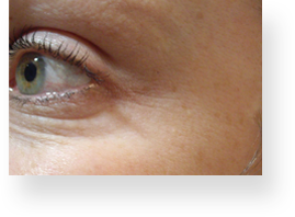 wrinkles_img2