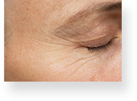 wrinkles_img3