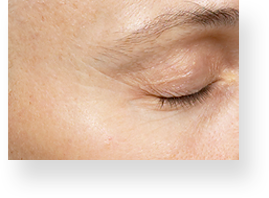 wrinkles_img4